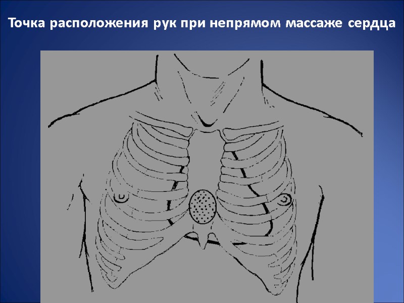Точка расположения рук при непрямом массаже сердца